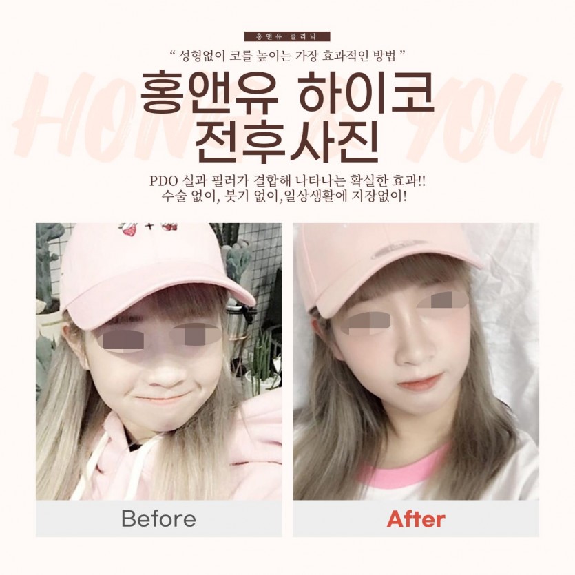 서울대입구, 서울대입구역, 서울, 피부과, 하이코,하이코필러,하이코필러잘하는곳, 신림, 사당, 봉천동, 신림역, 사당역, 봉천역, 낙성대, 낙성대역