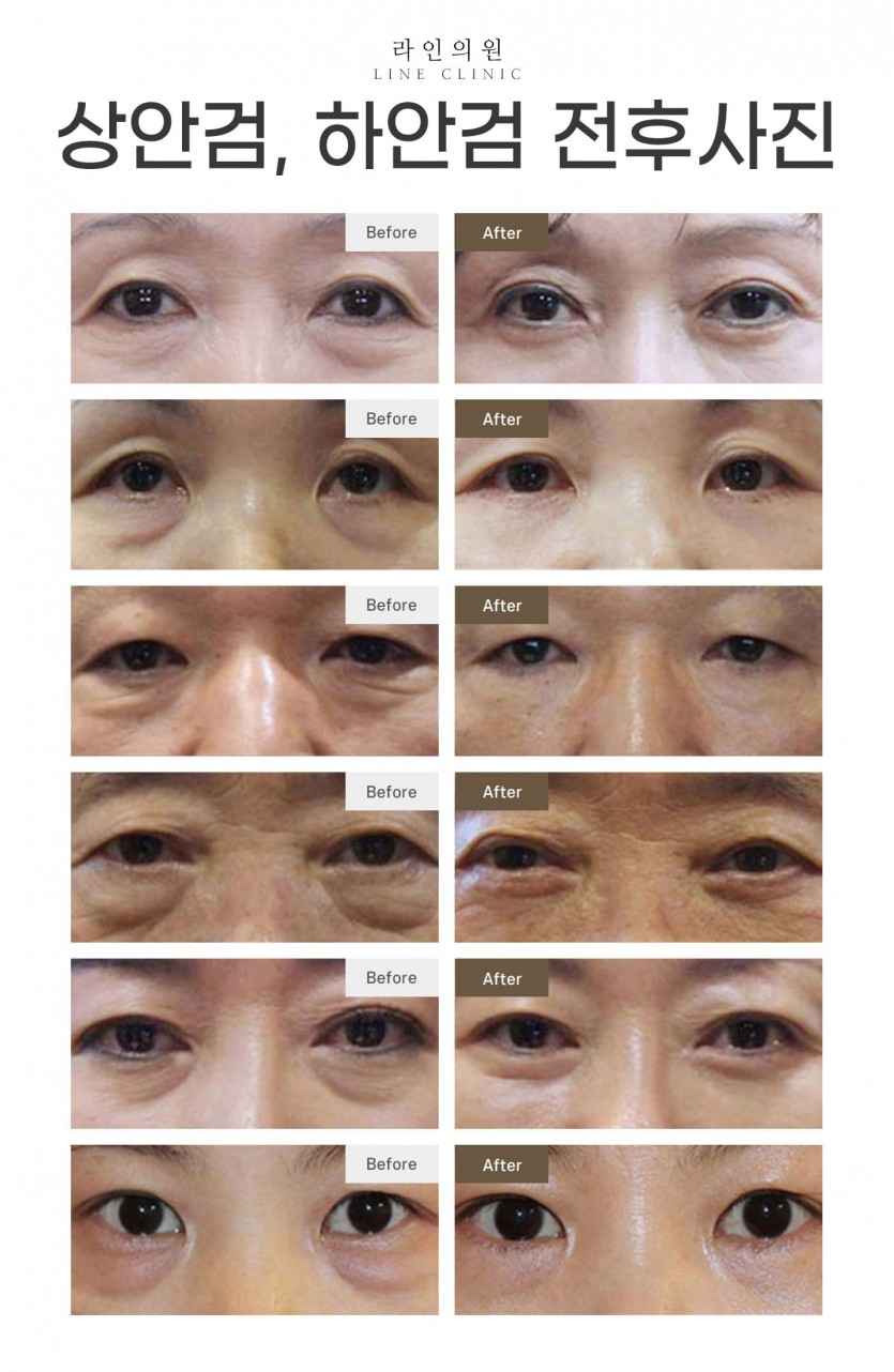 일산, 화정, 고양시, 피부과, 성형외과, 하안검, 하안검수술, 하안검후기, 라인의원, 화정역, 백석, 마두, 원당, 능곡, 행신동, 운정, 파주, 김포