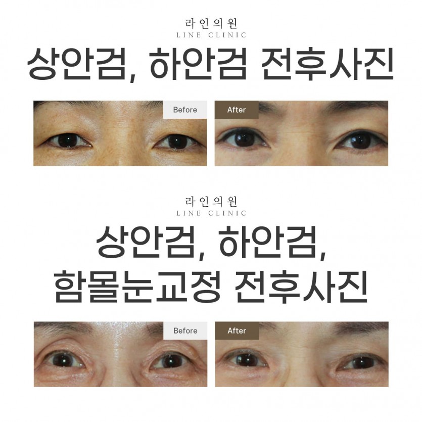 일산, 화정, 고양시, 피부과, 성형외과, 상안검, 상안검수술, 상안검후기, 라인의원, 화정역, 백석, 마두, 원당, 능곡, 행신동, 운정, 파주, 김포