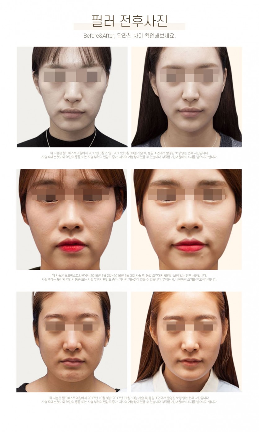 김포장기동피부과, 필러, 이마필러, 관자필러, 눈밑꺼짐필러, 애교살필러, 코필러, 무턱필러, 턱끝필러, 볼필러, 눈꺼풀필러, 레스틸렌필러, 국산필러, 15년이상 미용시술경력, 장기동피부과, 운양동피부과, 구래동피부과, 마산동피부과, 강화도피부과, 검단피부과, 장기역피부과, 최준원원장