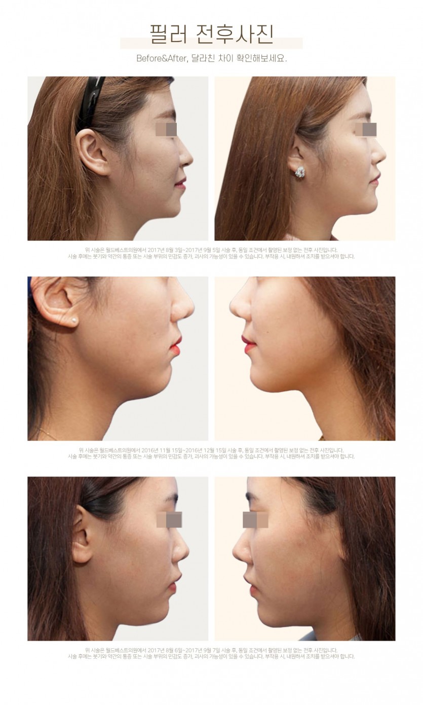 김포장기동피부과, 필러, 이마필러, 관자필러, 눈밑꺼짐필러, 애교살필러, 코필러, 무턱필러, 턱끝필러, 볼필러, 눈꺼풀필러, 레스틸렌필러, 국산필러, 15년이상 미용시술경력, 장기동피부과, 운양동피부과, 구래동피부과, 마산동피부과, 강화도피부과, 검단피부과, 장기역피부과, 최준원원장