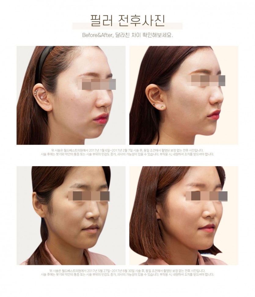 김포장기동피부과, 필러재시술, 이마필러, 관자필러, 눈밑꺼짐필러, 애교살필러, 코필러, 무턱필러, 턱끝필러, 볼필러, 눈꺼풀필러, 레스틸렌필러, 국산필러, 15년이상 미용시술경력, 장기동피부과, 운양동피부과, 구래동피부과, 마산동피부과, 강화도피부과, 검단피부과, 장기역피부과, 최준원원장