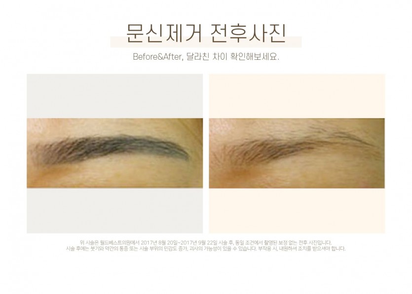 김포장기동피부과, 피코레이저, 피코문신제거, 피코타투제거, 타투제거, 15년이상 레이저시술경력, 미백레이저시술, 장기동피부과, 운양동피부과, 구래동피부과, 마산동피부과, 강화도피부과, 검단피부과, 장기역피부과, 최준원원장