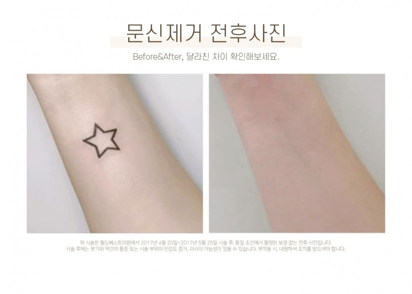 김포장기동피부과, 피코레이저, 피코문신제거, 피코타투제거, 타투제거, 15년이상 레이저시술경력, 미백레이저시술, 장기동피부과, 운양동피부과, 구래동피부과, 마산동피부과, 강화도피부과, 검단피부과, 장기역피부과, 최준원원장