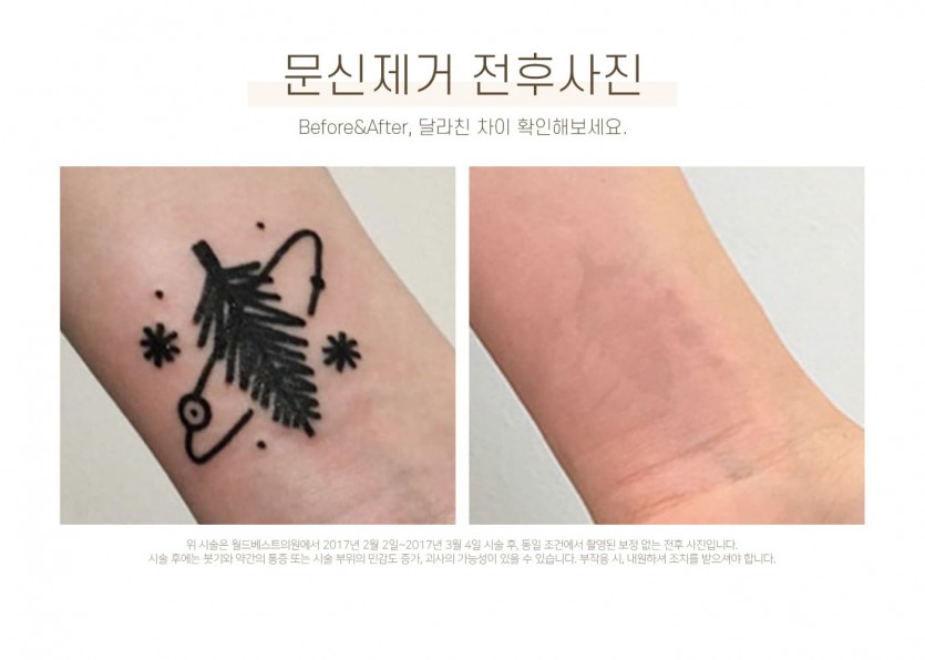 김포장기동피부과, 피코레이저, 피코문신제거, 피코타투제거, 타투제거, 15년이상 레이저시술경력, 미백레이저시술, 장기동피부과, 운양동피부과, 구래동피부과, 마산동피부과, 강화도피부과, 검단피부과, 장기역피부과, 최준원원장