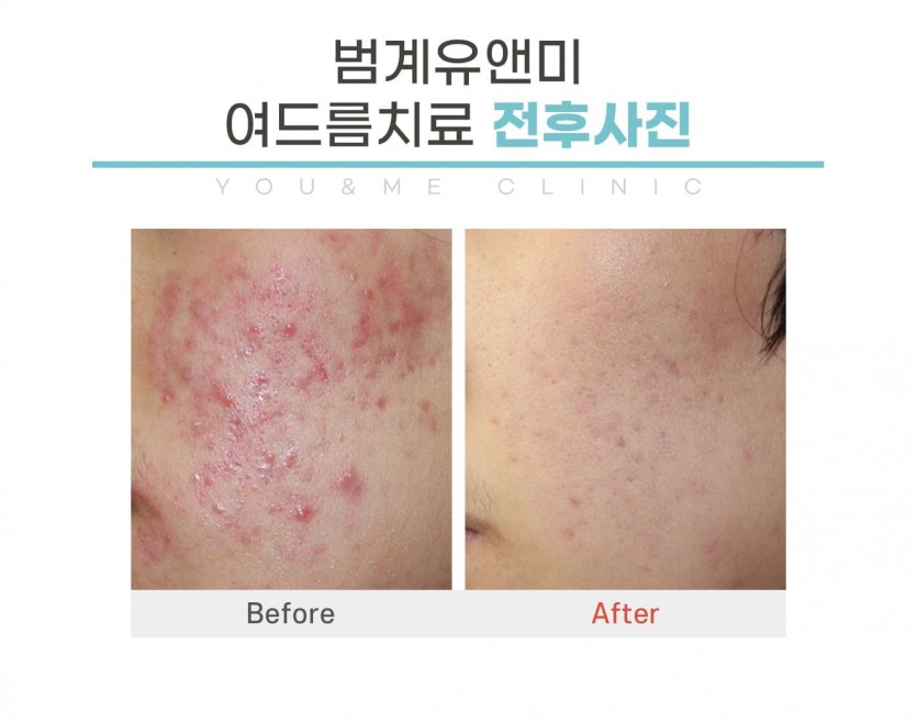 안양, 범계, 평촌, 여드름치료,여드름치료가격,성인여드름,피부과, 안양역, 범계역, 평촌역, 과천, 의왕, 군포, 안산, 시흥, 화성, 수원, 광명