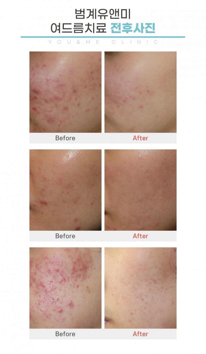 안양, 범계, 평촌, 여드름치료,여드름치료가격,성인여드름,피부과, 안양역, 범계역, 평촌역, 과천, 의왕, 군포, 안산, 시흥, 화성, 수원, 광명