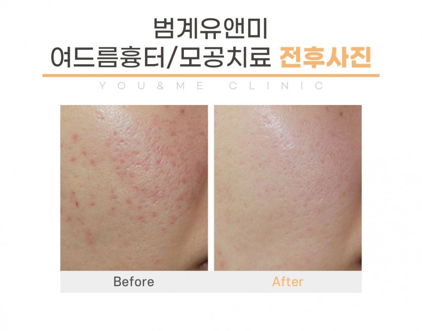 안양, 범계, 평촌, 여드름흉터, 여드름흉터치료, 여드름자국, 여드름, 피부과, 안양역, 범계역, 평촌역, 과천, 의왕, 군포, 안산, 시흥, 화성, 수원, 광명