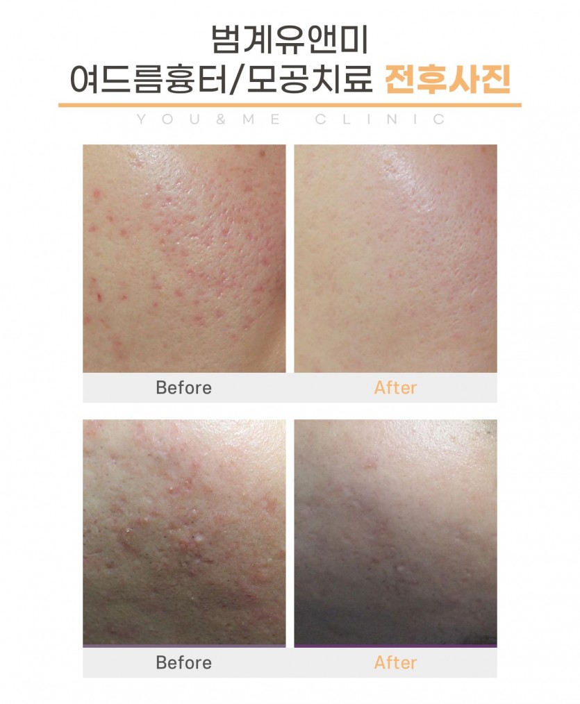 안양, 범계, 평촌, 여드름흉터, 여드름흉터치료, 여드름자국, 여드름, 피부과, 안양역, 범계역, 평촌역, 과천, 의왕, 군포, 안산, 시흥, 화성, 수원, 광명