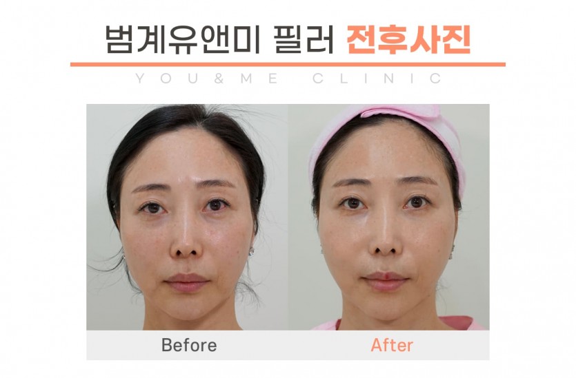 안양, 범계, 평촌, 필러, 레스틸렌, 필러잘하는곳, 피부과, 안양역, 범계역, 평촌역, 과천, 의왕, 군포, 안산, 시흥, 화성, 수원, 광명