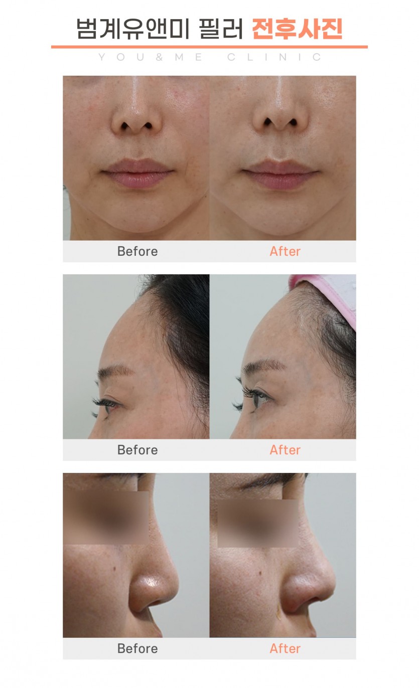 안양, 범계, 평촌, 필러, 레스틸렌, 필러잘하는곳, 피부과, 안양역, 범계역, 평촌역, 과천, 의왕, 군포, 안산, 시흥, 화성, 수원, 광명