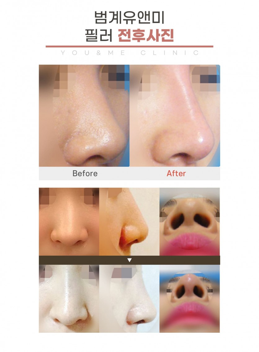 안양, 범계, 평촌, 하이코, 하이코필러, 하이코잘하는곳, 피부과, 안양역, 범계역, 평촌역, 과천, 의왕, 군포, 안산, 시흥, 화성, 수원, 광명