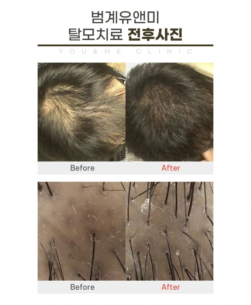 유앤미의원, 안양, 범계, 평촌, 의왕, 군포, 과천, 탈모치료, 모낭주사, 안산, 화성, 광명, 수원, 탈모병원, 탈모피부과, 탈모추천, 탈모잘하는피부과, 여성탈모, 남성탈모